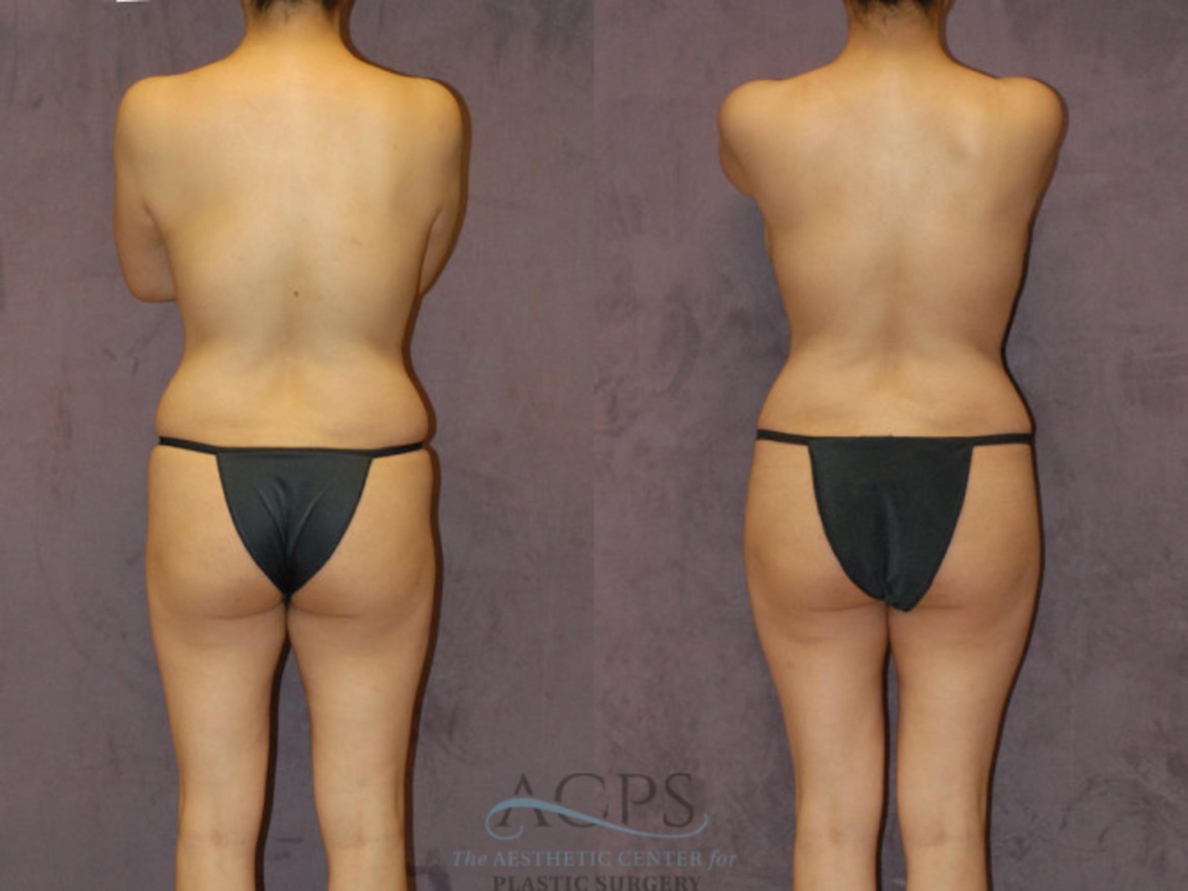 Before & After Brazilian Butt Lift (BBL) Case 426 Rear View: View in Houston, TX
