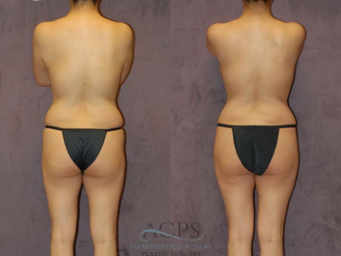 Before & After Brazilian Butt Lift (BBL) Case 426 Rear View: View in Houston, TX