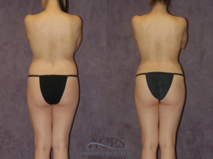 Before & After Brazilian Butt Lift (BBL) Case 427 Rear View: View in Houston, TX