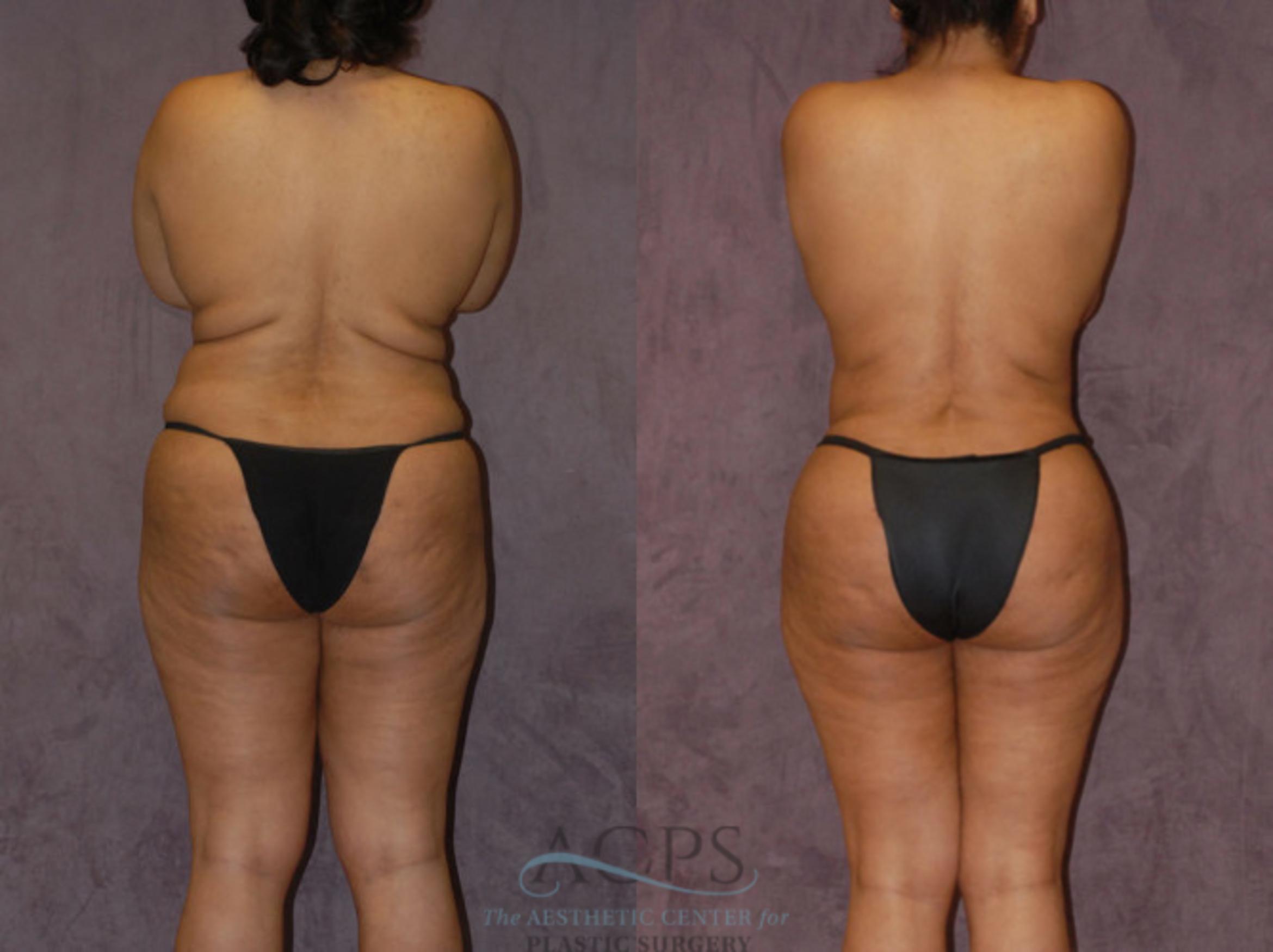 Before & After Brazilian Butt Lift (BBL) Case 428 Rear View: View in Houston, TX