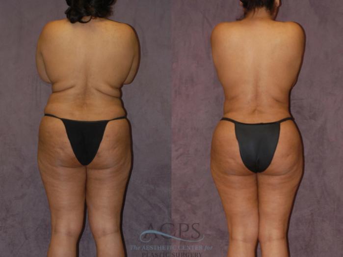 Before & After Brazilian Butt Lift (BBL) Case 428 Rear View: View in Houston, TX