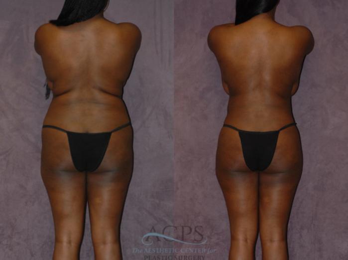 Before & After Brazilian Butt Lift (BBL) Case 429 Rear View: View in Houston, TX