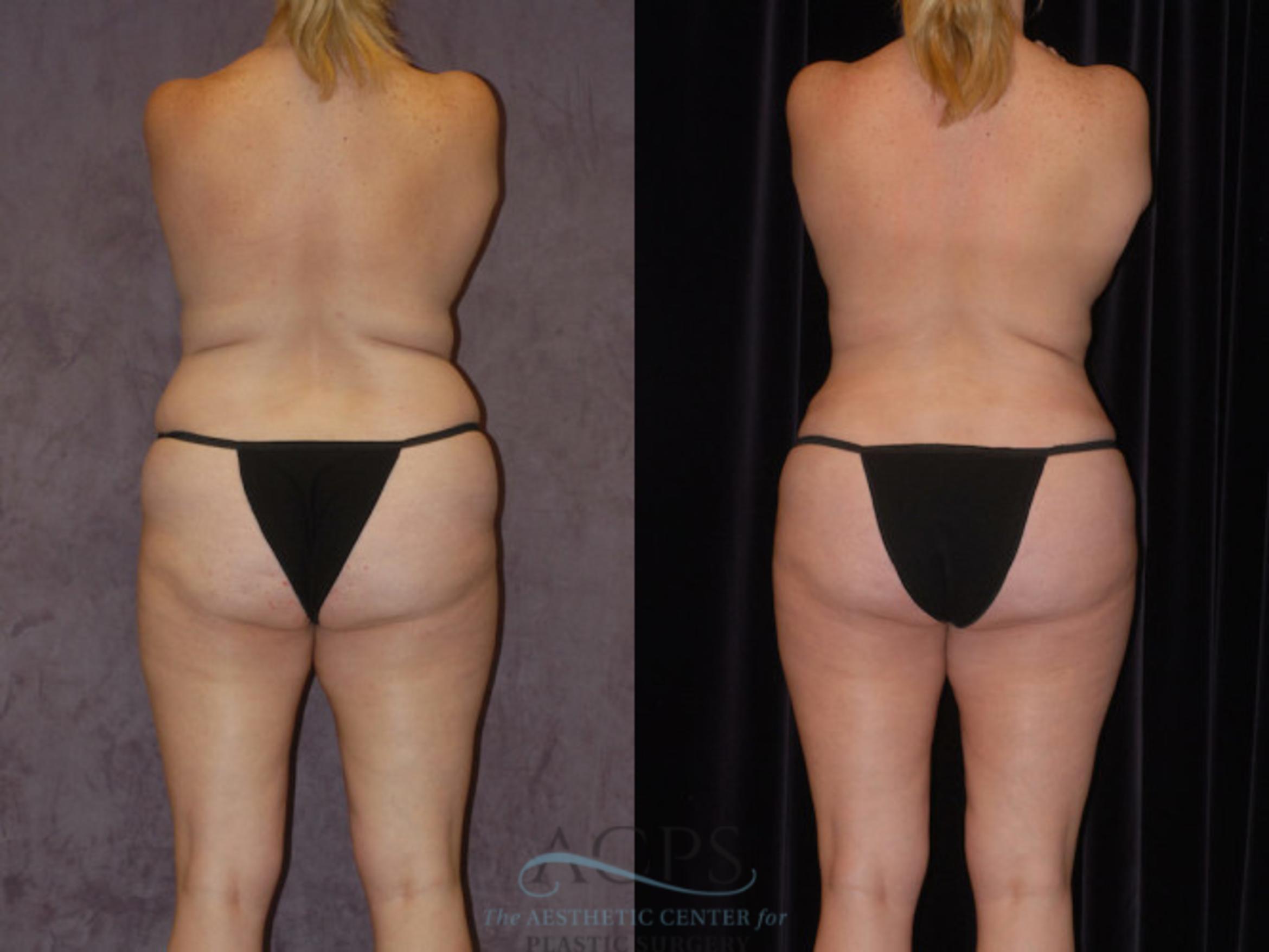 Before & After Brazilian Butt Lift (BBL) Case 430 Rear View: View in Houston, TX