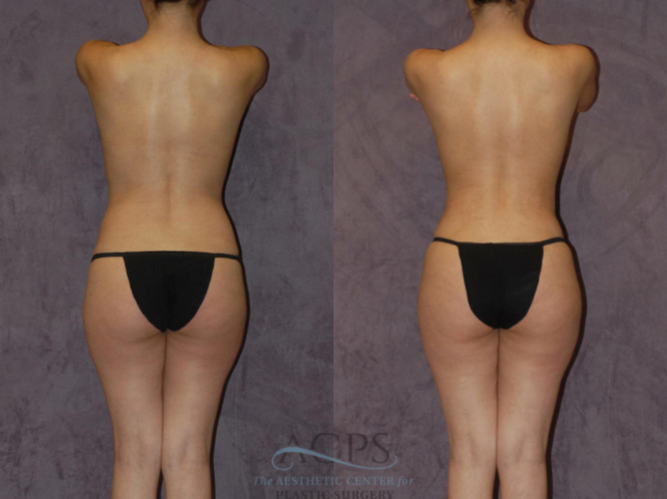 Before & After Brazilian Butt Lift (BBL) Case 432 Rear View: View in Houston, TX