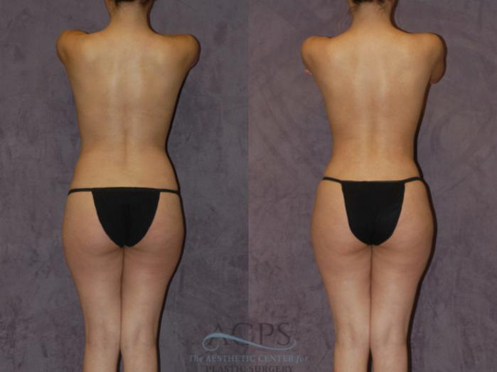 Before & After Brazilian Butt Lift (BBL) Case 432 Rear View: View in Houston, TX