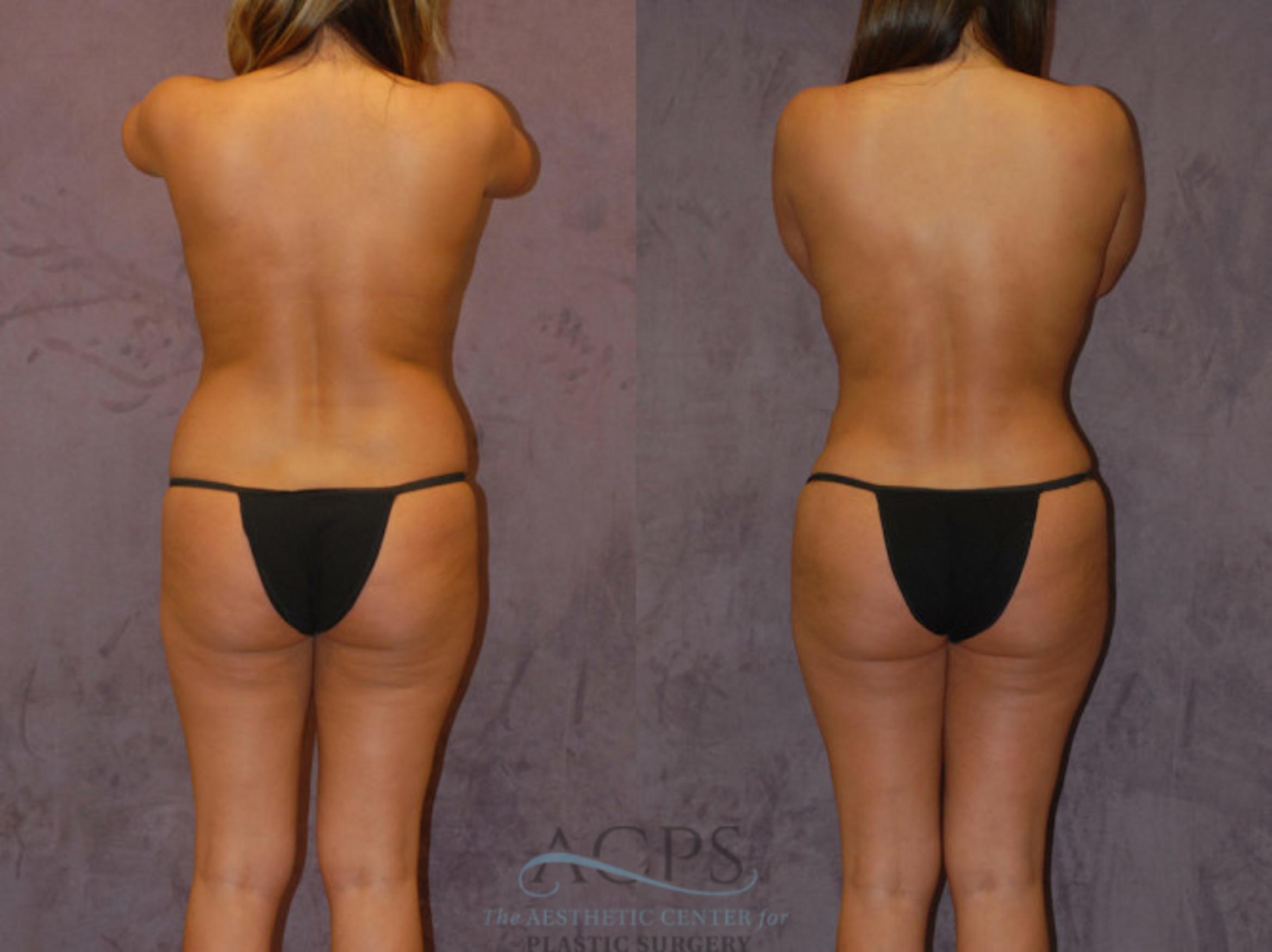 Before & After Brazilian Butt Lift (BBL) Case 433 Rear View: View in Houston, TX