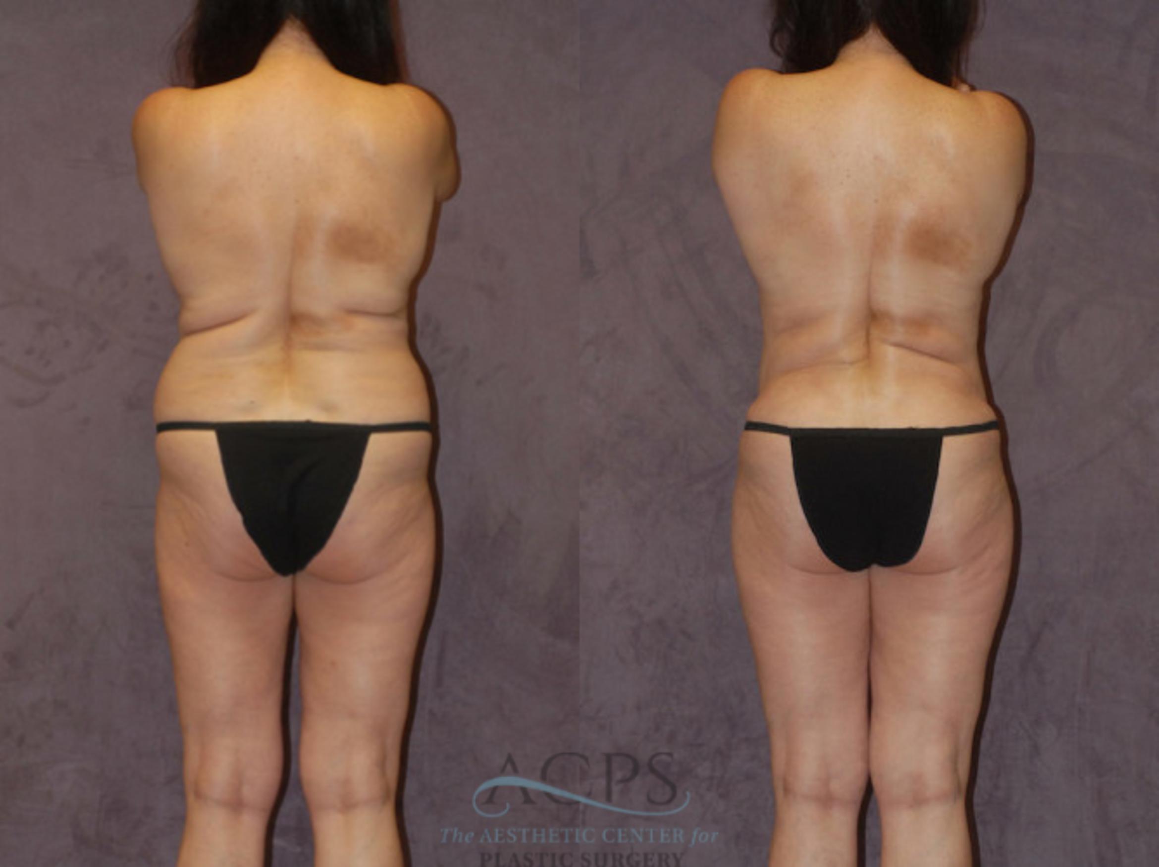 Before & After Brazilian Butt Lift (BBL) Case 434 Rear View: View in Houston, TX