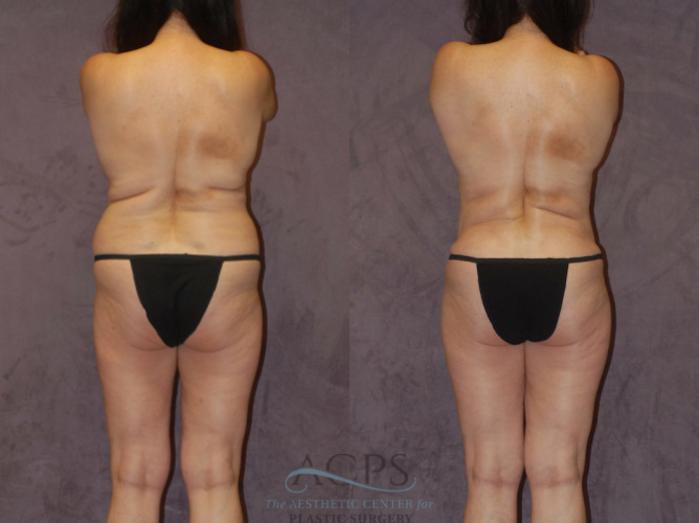 Before & After Brazilian Butt Lift (BBL) Case 434 Rear View: View in Houston, TX