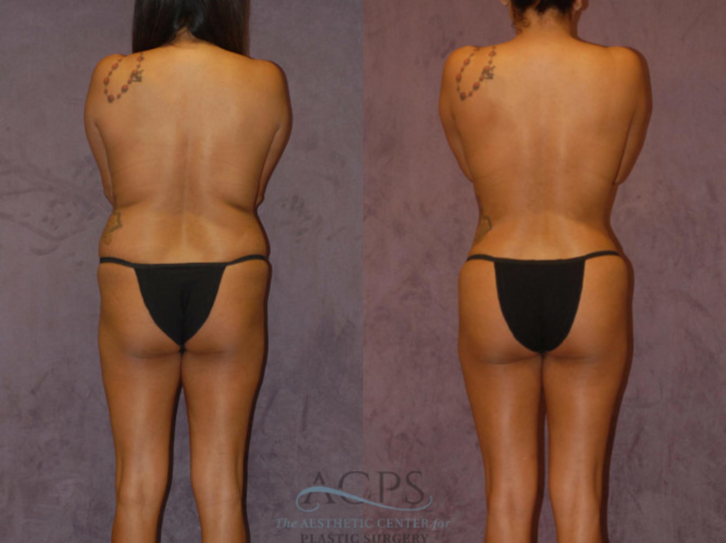 Before & After Brazilian Butt Lift (BBL) Case 435 Rear View: View in Houston, TX