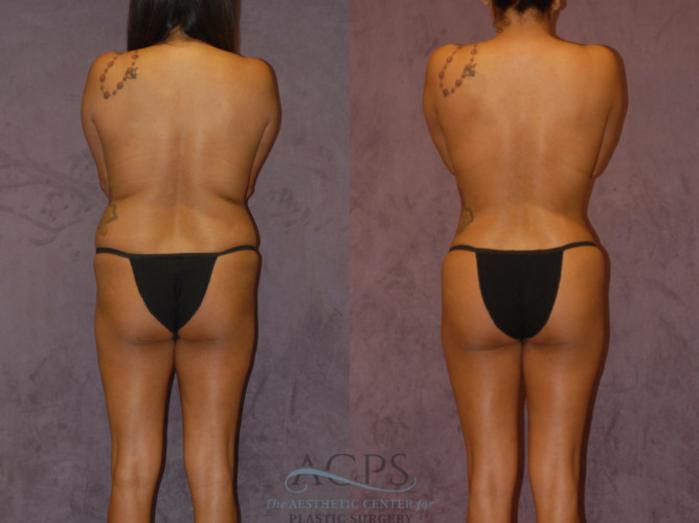 Before & After Brazilian Butt Lift (BBL) Case 435 Rear View: View in Houston, TX