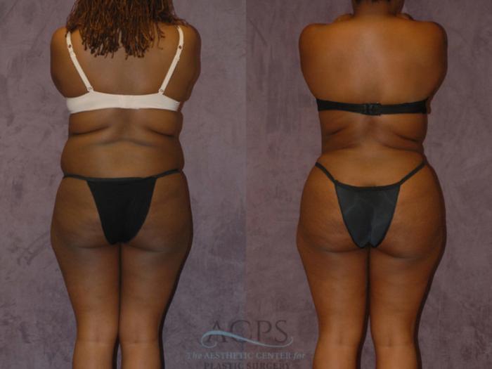 Before & After Brazilian Butt Lift (BBL) Case 436 Rear View: View in Houston, TX