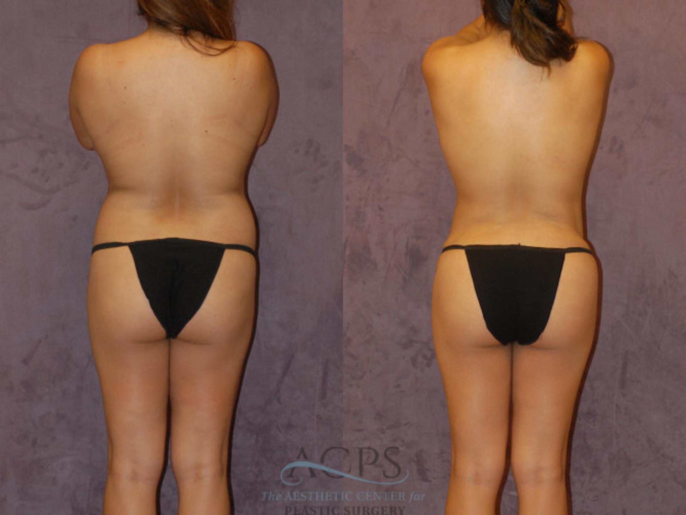 Before & After Brazilian Butt Lift (BBL) Case 437 Rear View: View in Houston, TX