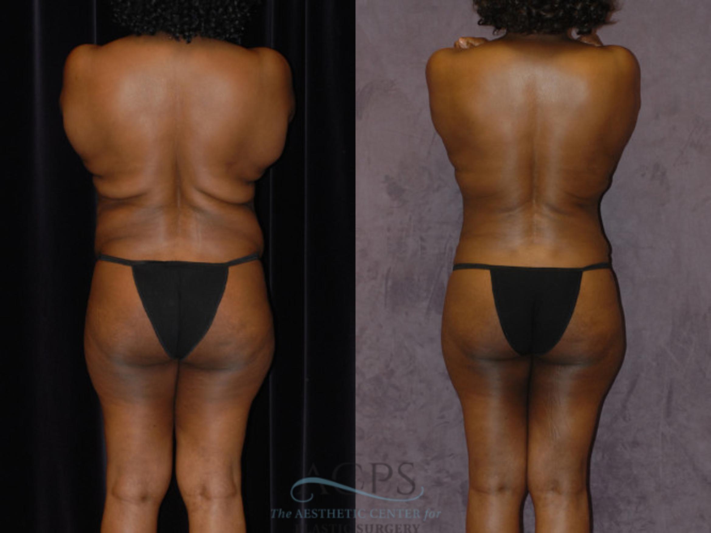 Before & After Brazilian Butt Lift (BBL) Case 438 Rear View: View in Houston, TX