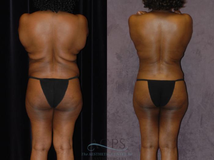 Before & After Brazilian Butt Lift (BBL) Case 438 Rear View: View in Houston, TX