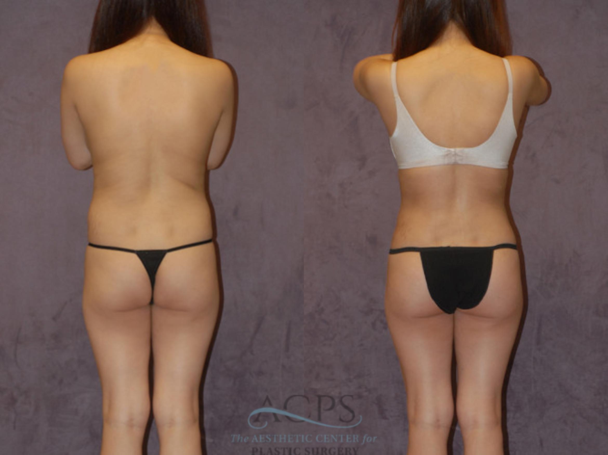 Before & After Brazilian Butt Lift (BBL) Case 439 Rear View: View in Houston, TX
