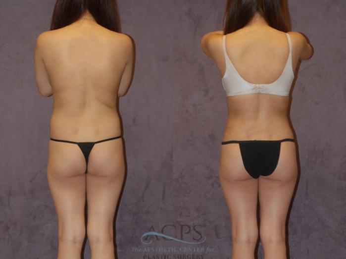Before & After Brazilian Butt Lift (BBL) Case 439 Rear View: View in Houston, TX