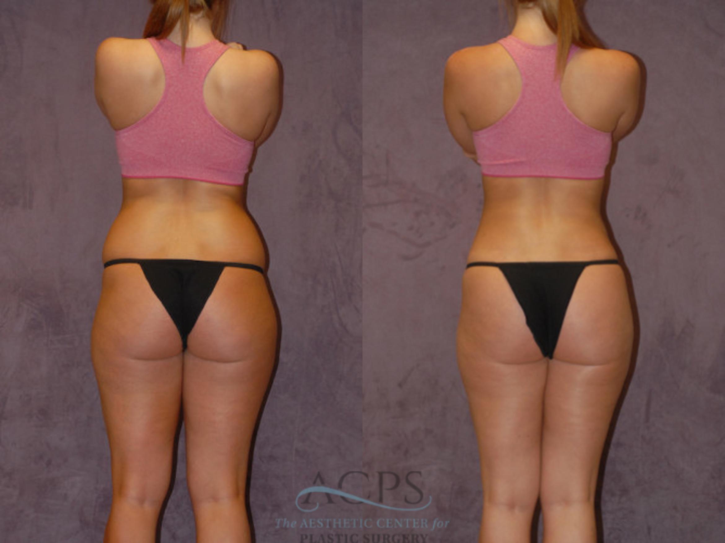 Before & After Brazilian Butt Lift (BBL) Case 440 Rear View: View in Houston, TX