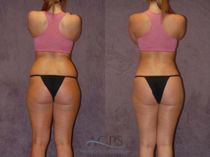 Before & After Brazilian Butt Lift (BBL) Case 440 Rear View: View in Houston, TX