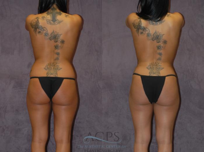 Before & After Brazilian Butt Lift (BBL) Case 442 Rear View: View in Houston, TX