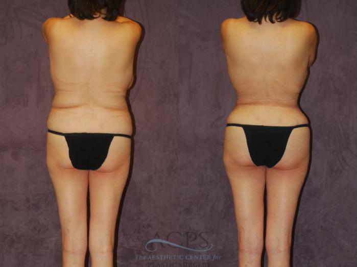 Before & After Brazilian Butt Lift (BBL) Case 443 Rear View: View in Houston, TX
