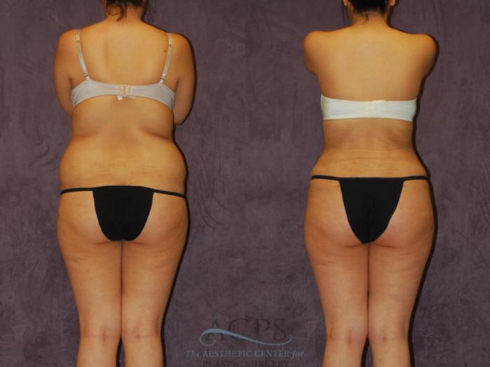Before & After Brazilian Butt Lift (BBL) Case 444 Rear View: View in Houston, TX