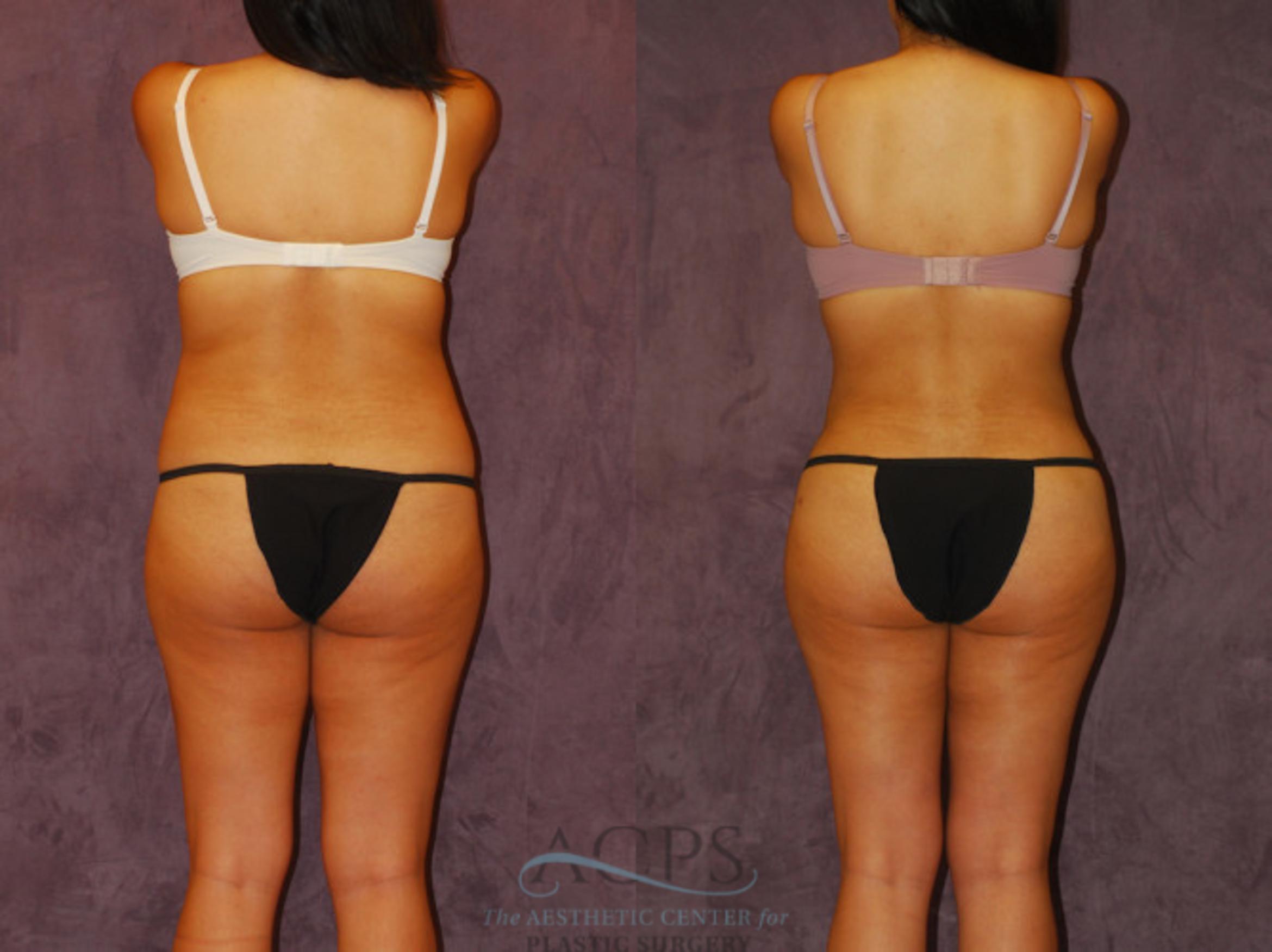Before & After Brazilian Butt Lift (BBL) Case 445 Rear View: View in Houston, TX