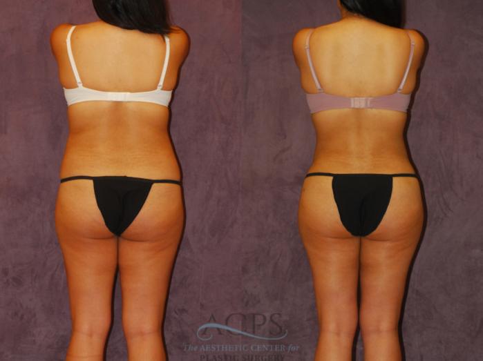 Before & After Brazilian Butt Lift (BBL) Case 445 Rear View: View in Houston, TX