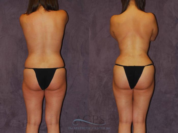 Before & After Brazilian Butt Lift (BBL) Case 447 Rear View: View in Houston, TX