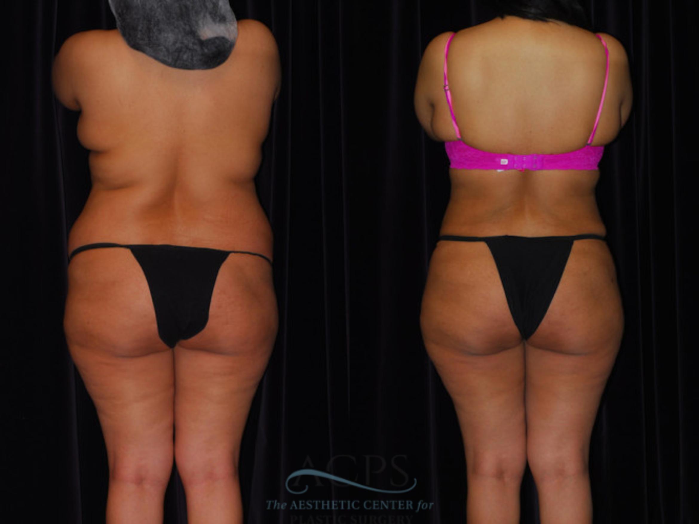 Before & After Brazilian Butt Lift (BBL) Case 448 Rear View: View in Houston, TX