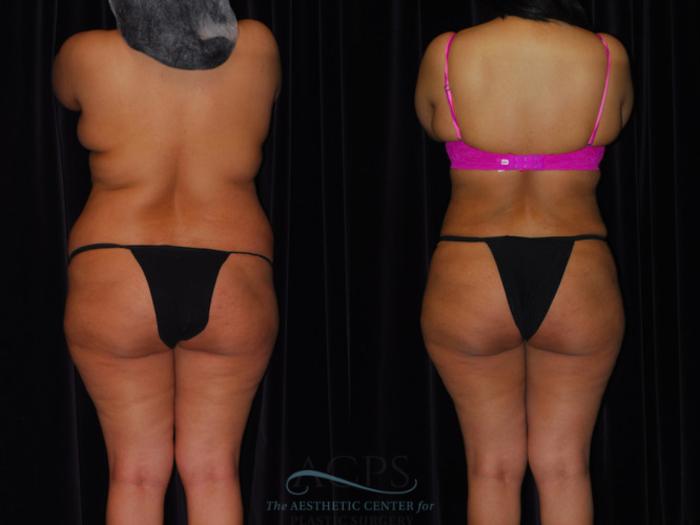 Before & After Brazilian Butt Lift (BBL) Case 448 Rear View: View in Houston, TX