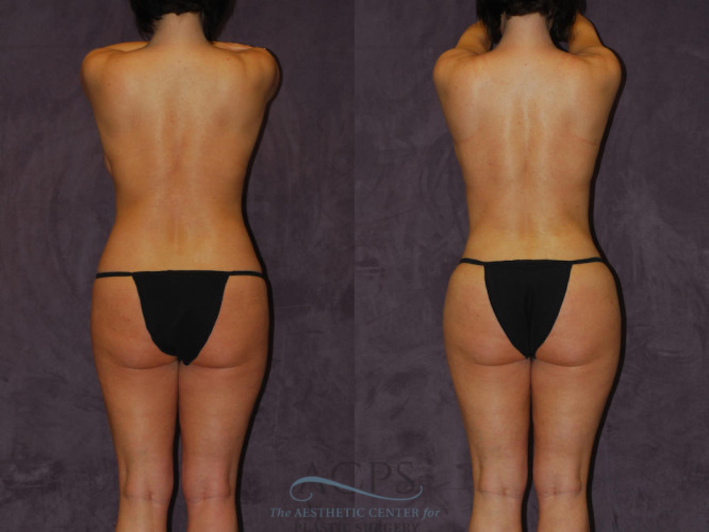 Before & After Brazilian Butt Lift (BBL) Case 449 Rear View: View in Houston, TX
