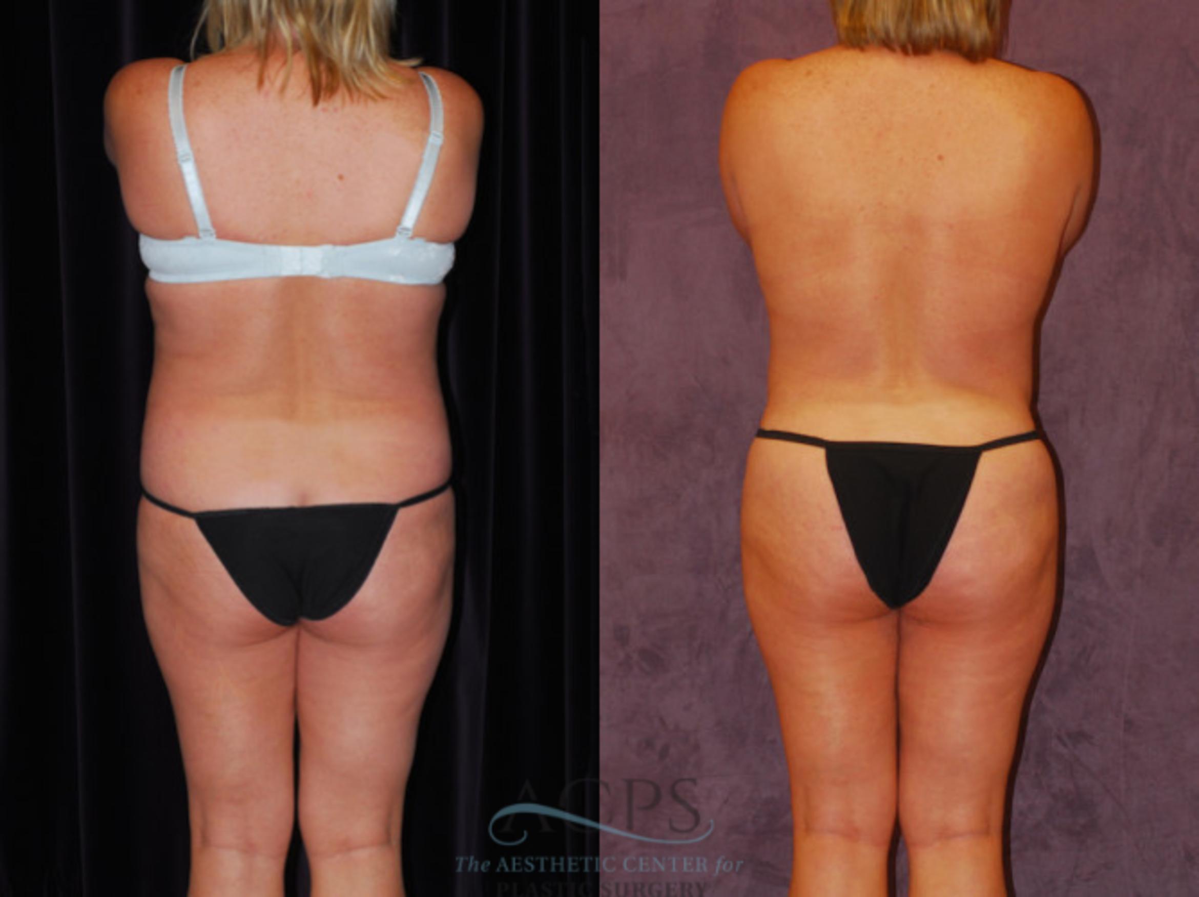 Before & After Brazilian Butt Lift (BBL) Case 450 Rear View: View in Houston, TX