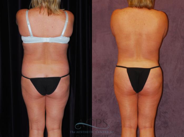 Before & After Brazilian Butt Lift (BBL) Case 450 Rear View: View in Houston, TX