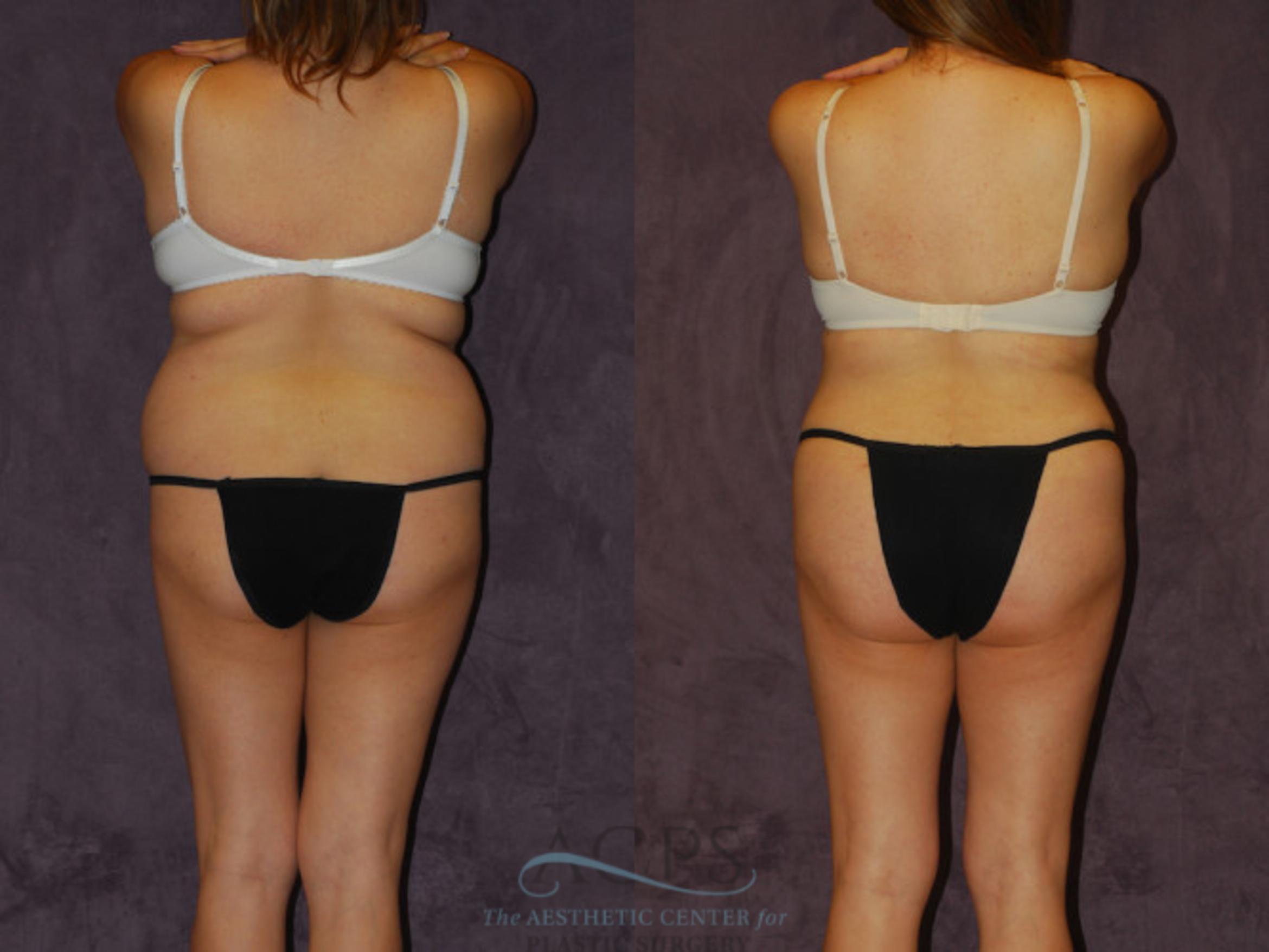 Before & After Brazilian Butt Lift (BBL) Case 451 Rear View: View in Houston, TX