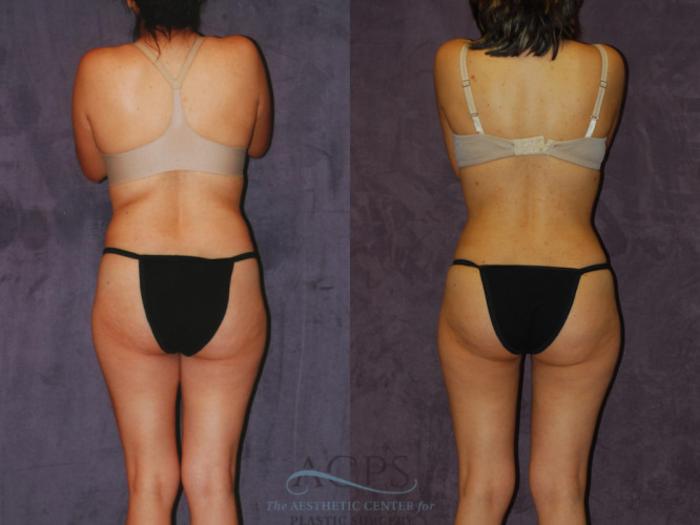 Before & After Brazilian Butt Lift (BBL) Case 452 Rear View: View in Houston, TX