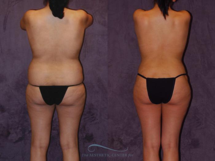 Before & After Brazilian Butt Lift (BBL) Case 453 Rear View: View in Houston, TX