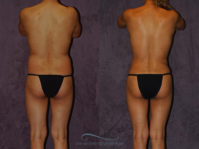 Before & After Brazilian Butt Lift (BBL) Case 454 Rear View: View in Houston, TX