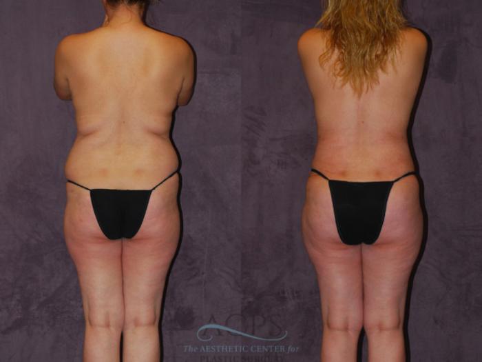 Before & After Brazilian Butt Lift (BBL) Case 455 Rear View: View in Houston, TX