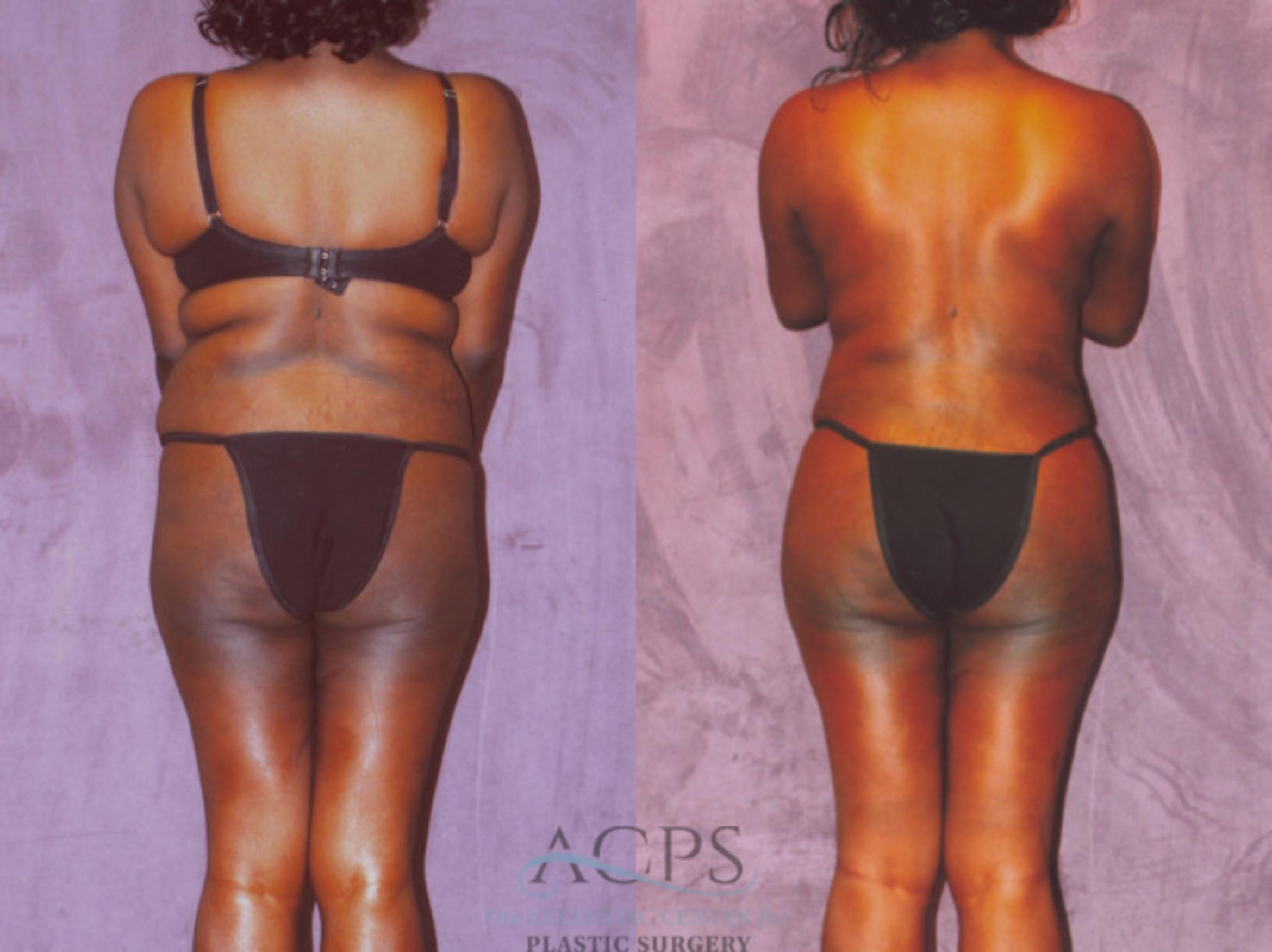 Before & After Brazilian Butt Lift (BBL) Case 456 Rear View: View in Houston, TX