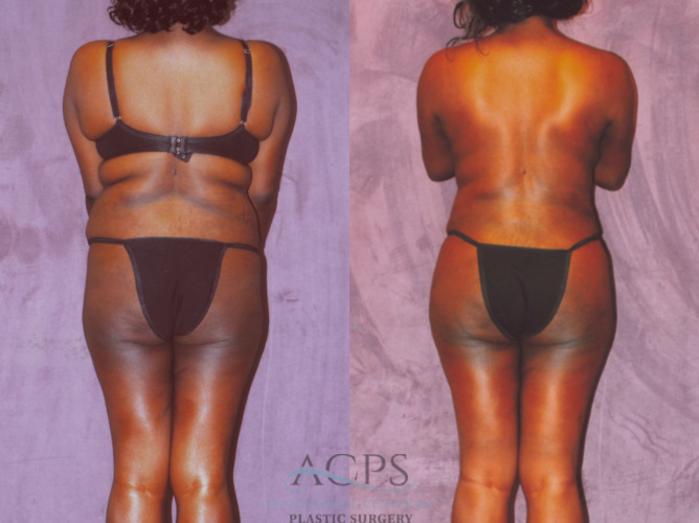 Before & After Brazilian Butt Lift (BBL) Case 456 Rear View: View in Houston, TX