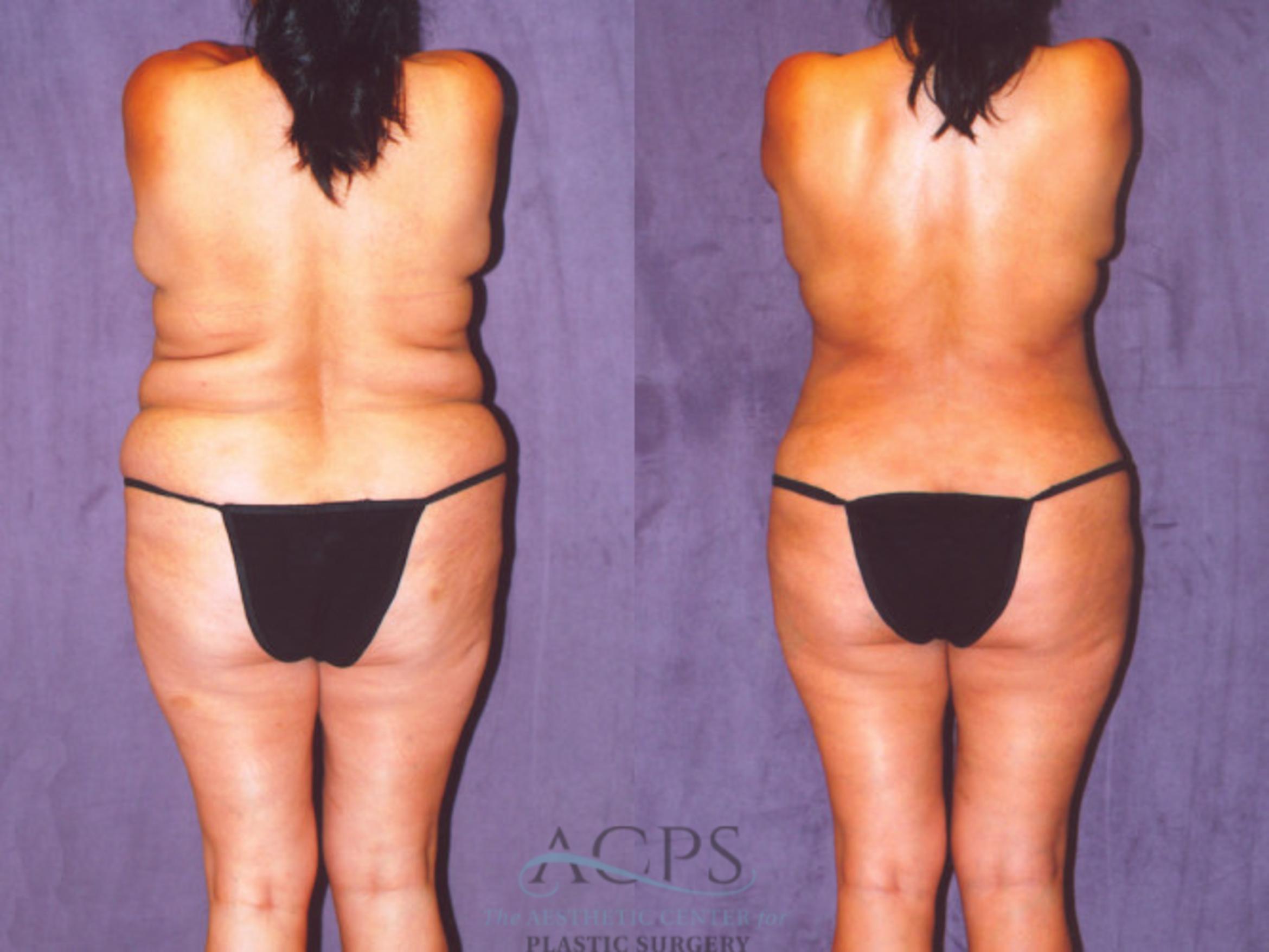Before & After Brazilian Butt Lift (BBL) Case 457 Rear View: View in Houston, TX