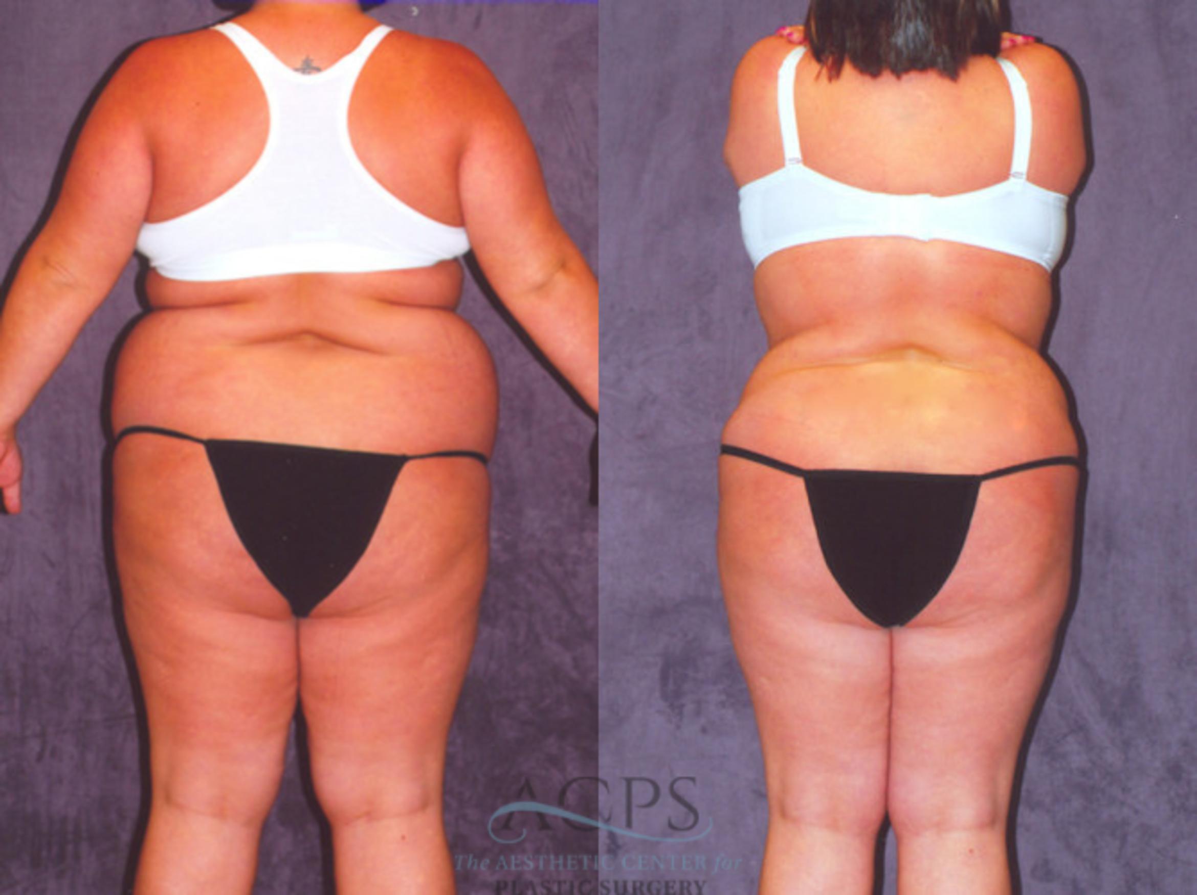 Before & After Brazilian Butt Lift (BBL) Case 458 Rear View: View in Houston, TX