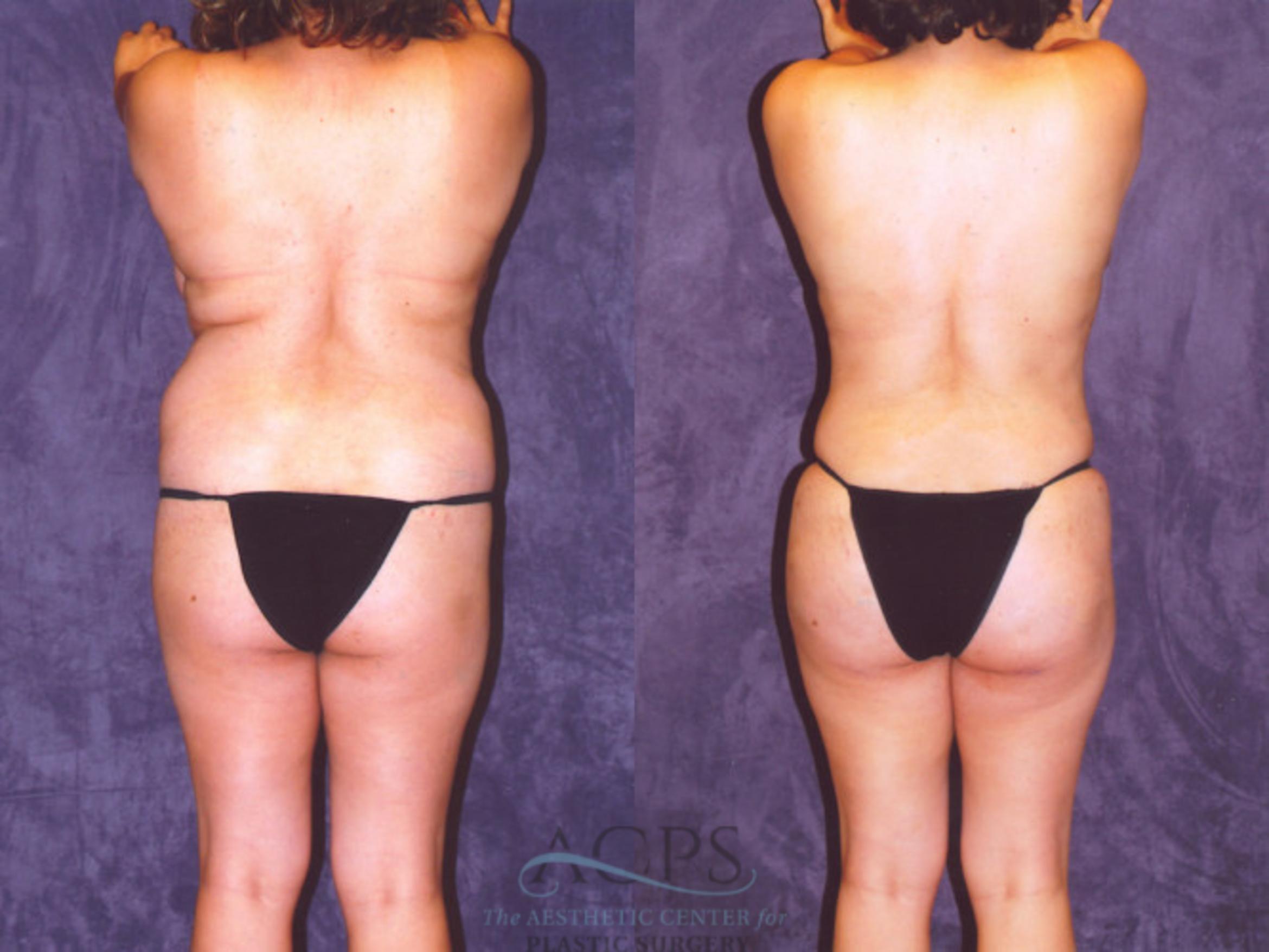 Before & After Brazilian Butt Lift (BBL) Case 459 Rear View: View in Houston, TX