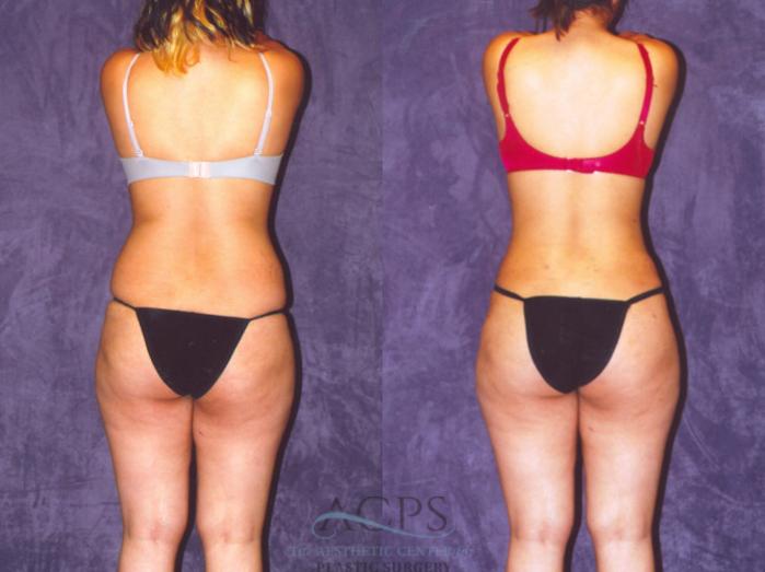 Before & After Brazilian Butt Lift (BBL) Case 460 Rear View: View in Houston, TX