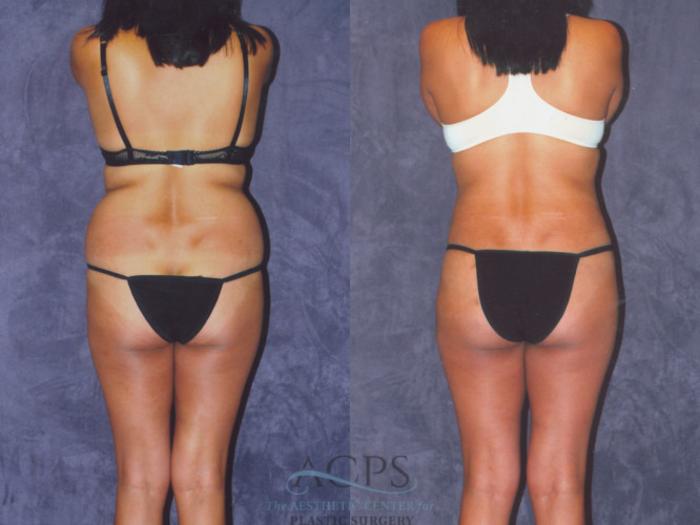 Before & After Brazilian Butt Lift (BBL) Case 462 Rear View: View in Houston, TX