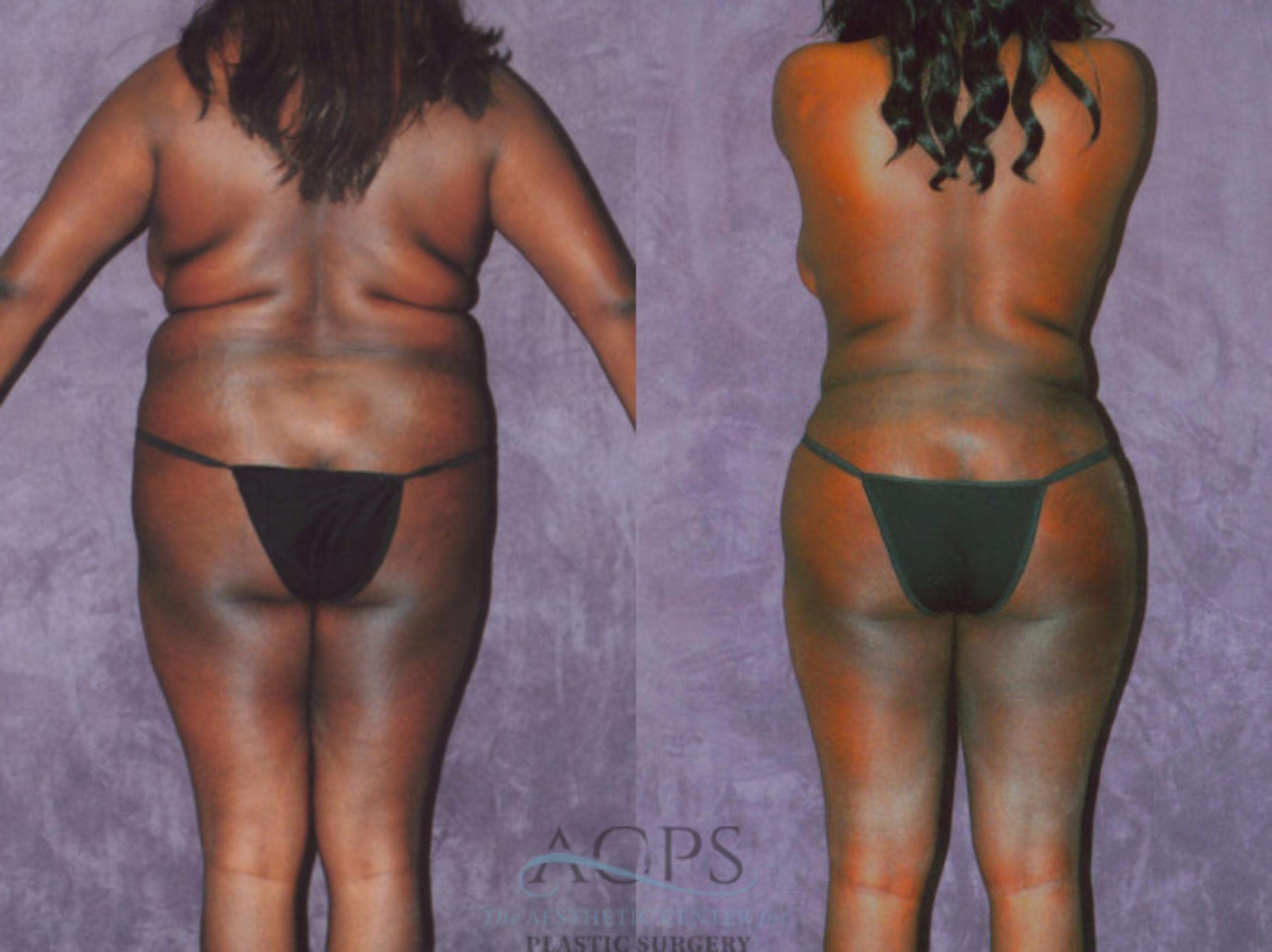 Before & After Brazilian Butt Lift (BBL) Case 463 Rear View: View in Houston, TX