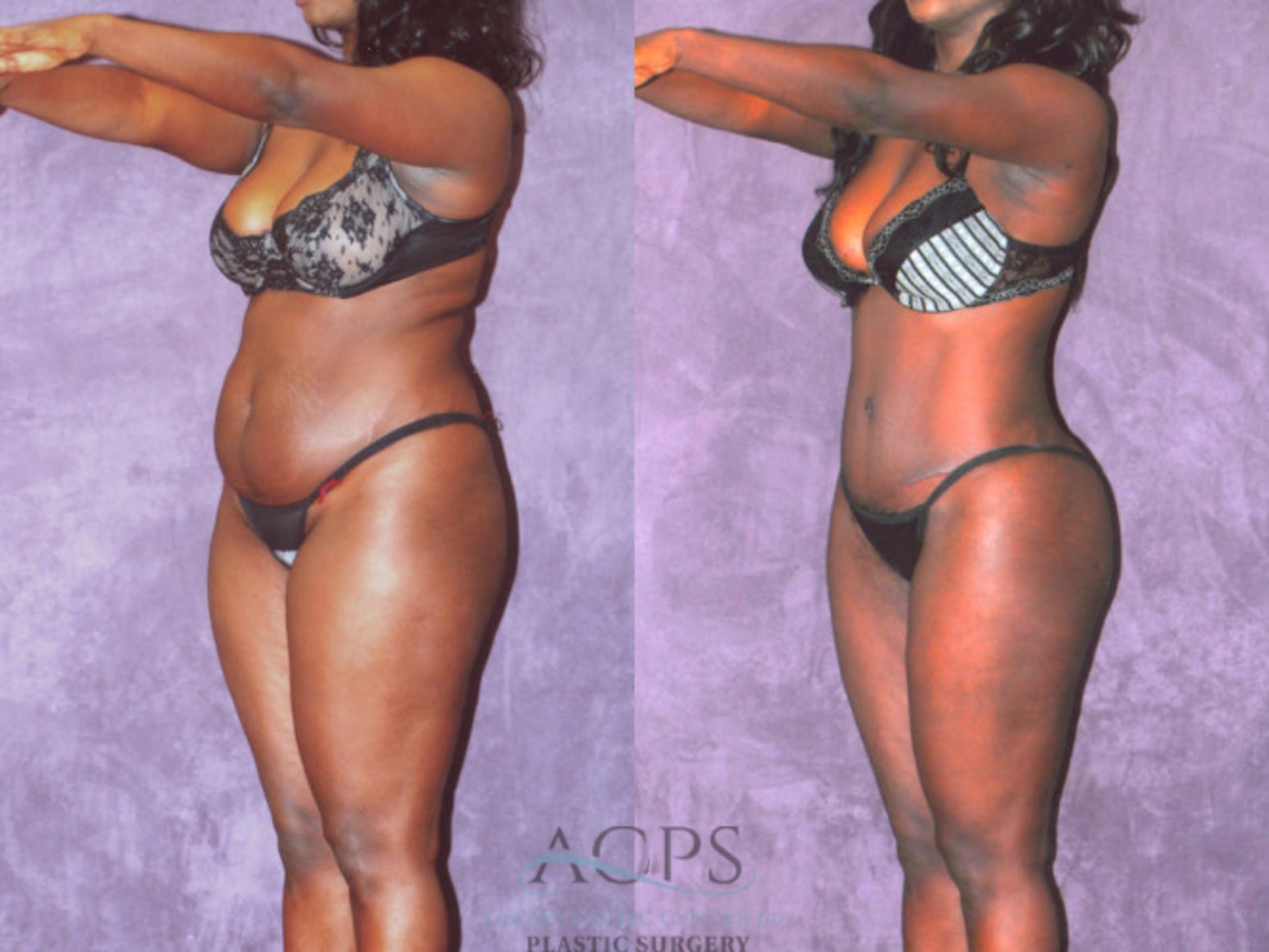 Before & After Brazilian Butt Lift (BBL) Case 464 Oblique View: View in Houston, TX