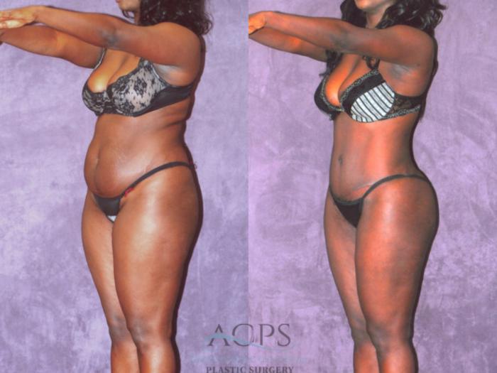 Before & After Brazilian Butt Lift (BBL) Case 464 Oblique View: View in Houston, TX