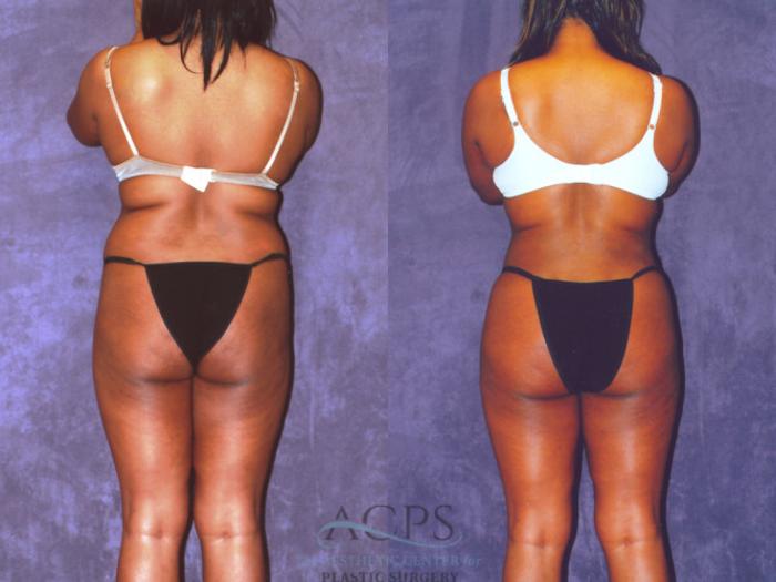 Before & After Brazilian Butt Lift (BBL) Case 465 Rear View: View in Houston, TX