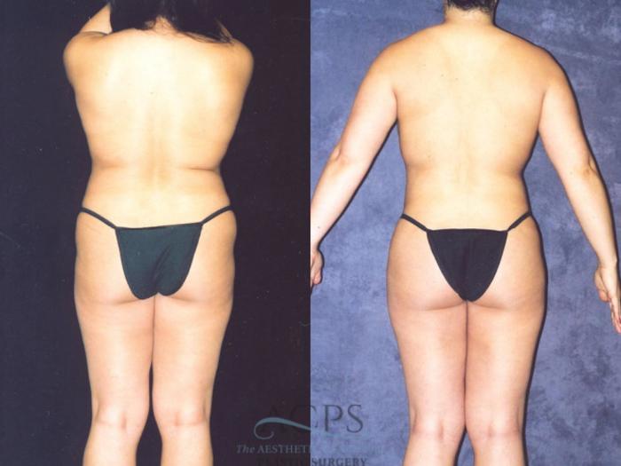 Before & After Brazilian Butt Lift (BBL) Case 466 Rear View: View in Houston, TX